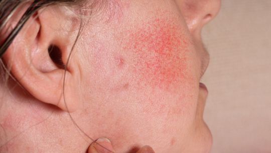 Reakcje alergiczne a trądzik różowaty – jak rozpoznać i unikać dodatkowych podrażnień?